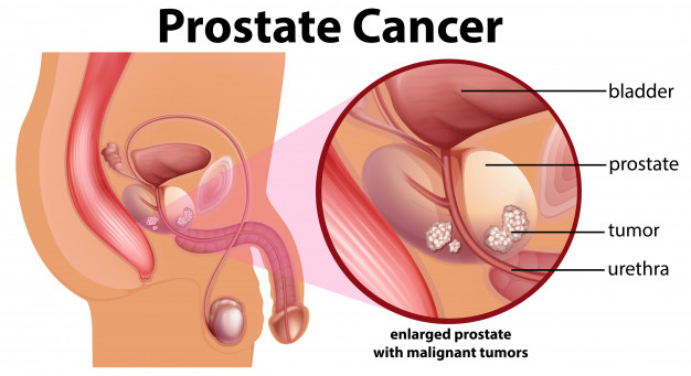 Cancerul de prostata – o sentinţa capitala?